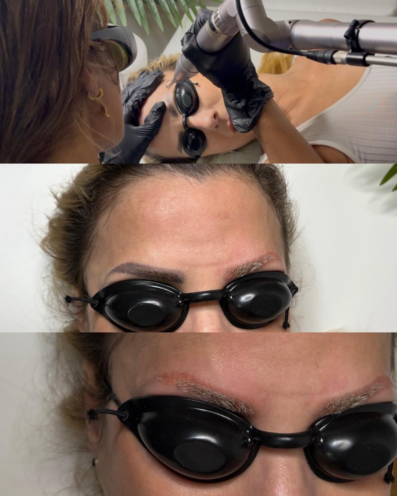 Effacer tatouage Lausanne - Résultat visible