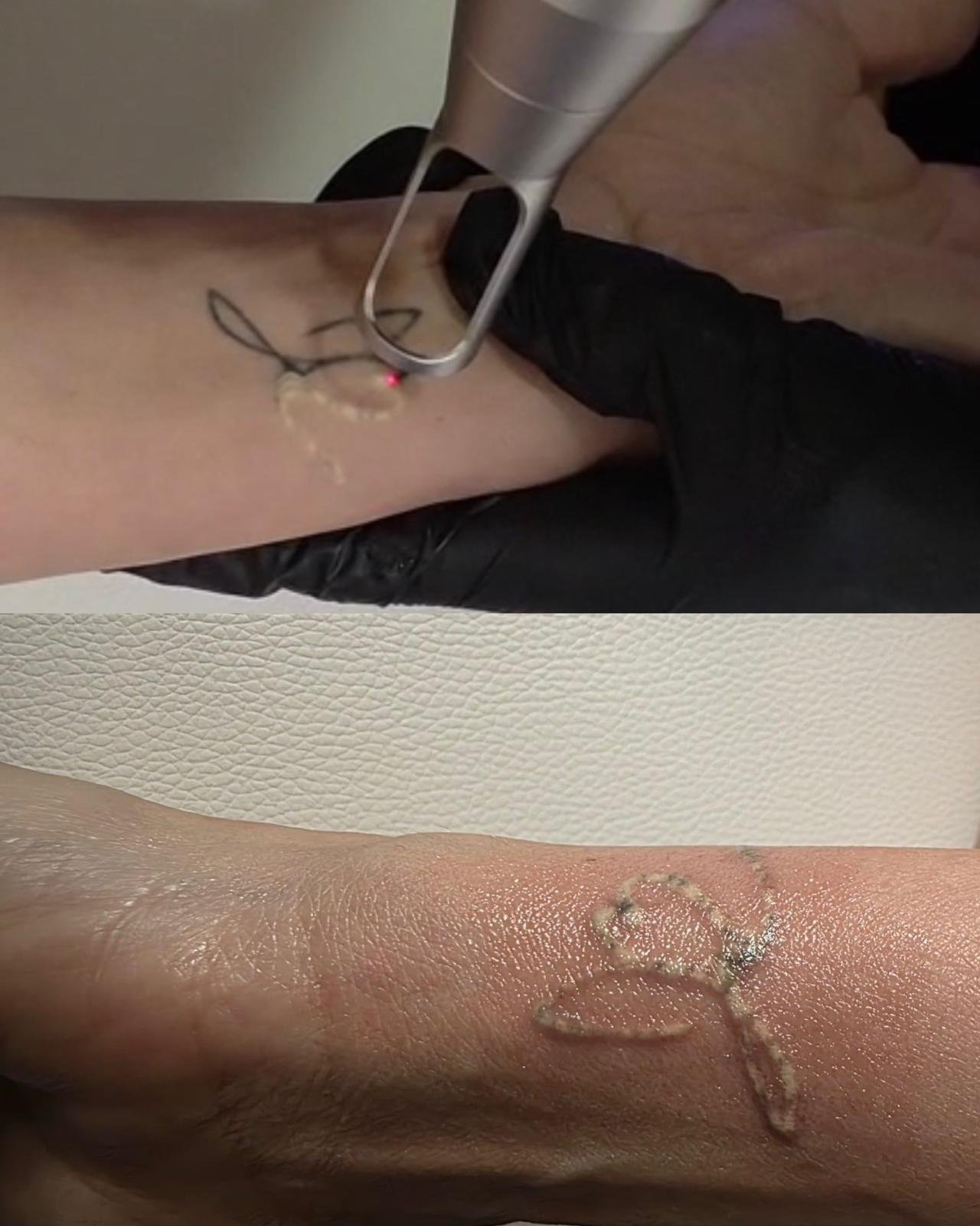 Enlever tatouage Lausanne - Laser picoseconde